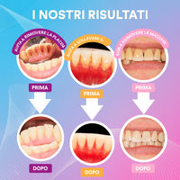 5-in-1 Ultrasonic Tooth Cleaner